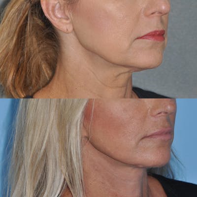 Facelift Before & After Gallery - Patient 127520 - Image 2