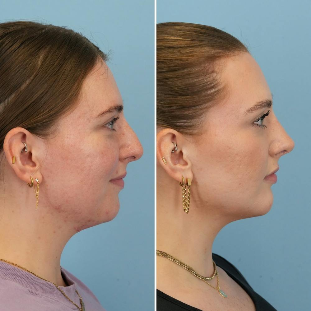 Chin Implant Before & After Gallery - Patient 176883825 - Image 2