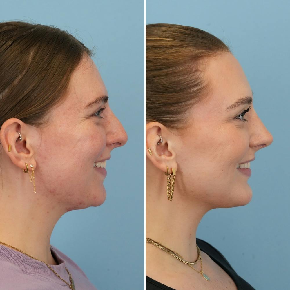 Chin Implant Before & After Gallery - Patient 176883825 - Image 4