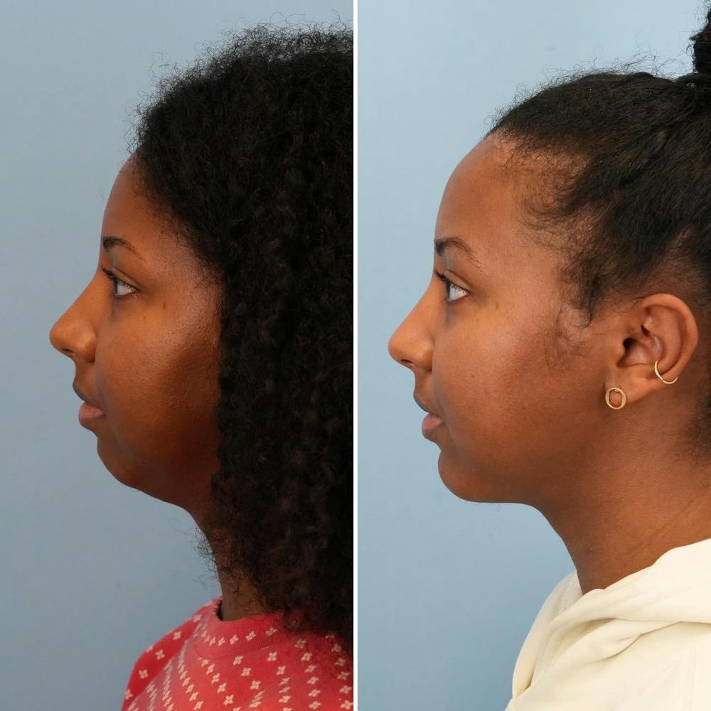 Chin Implant Before & After Gallery - Patient 116642 - Image 2
