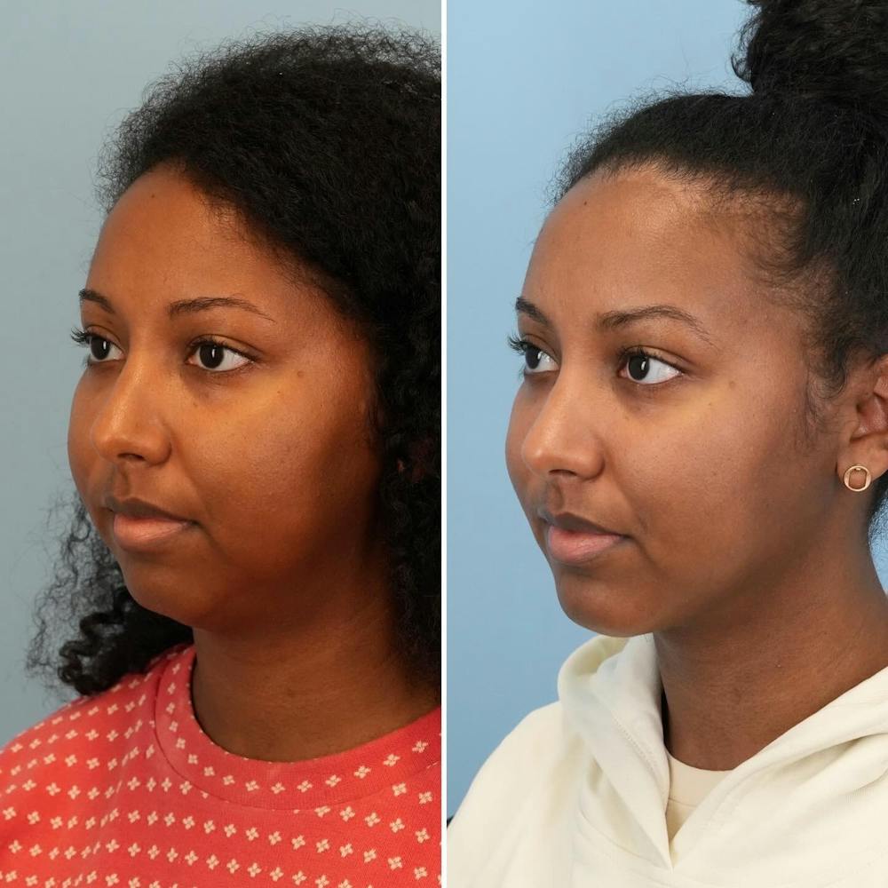 Chin Implant Before & After Gallery - Patient 116642 - Image 3
