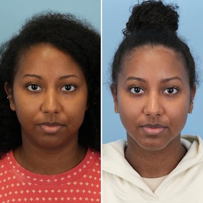Chin Implant Before & After Gallery - Patient 116642 - Image 1