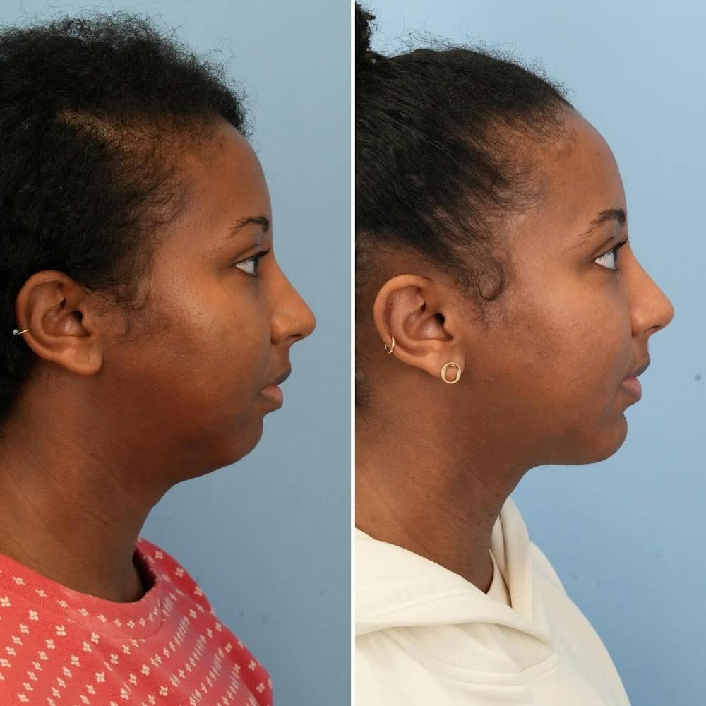 Chin Implant Before & After Gallery - Patient 116642 - Image 4