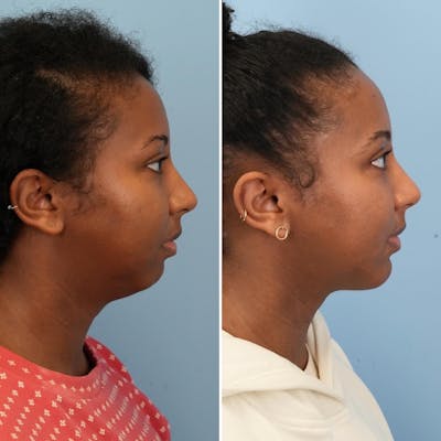 Chin Implant Before & After Gallery - Patient 116642 - Image 4