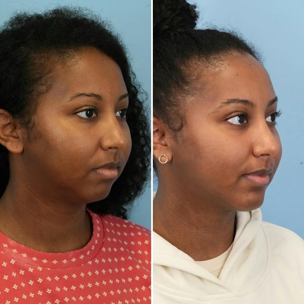 Chin Implant Before & After Gallery - Patient 116642 - Image 5