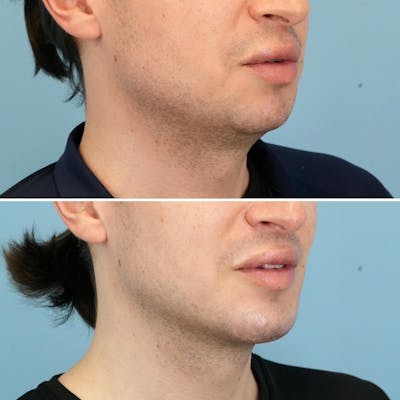 Chin Implant Before & After Gallery - Patient 213912 - Image 2