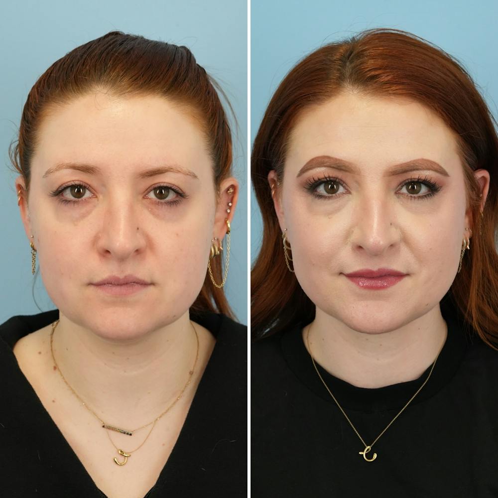 THERMItight Before & After Gallery - Patient 174293 - Image 3