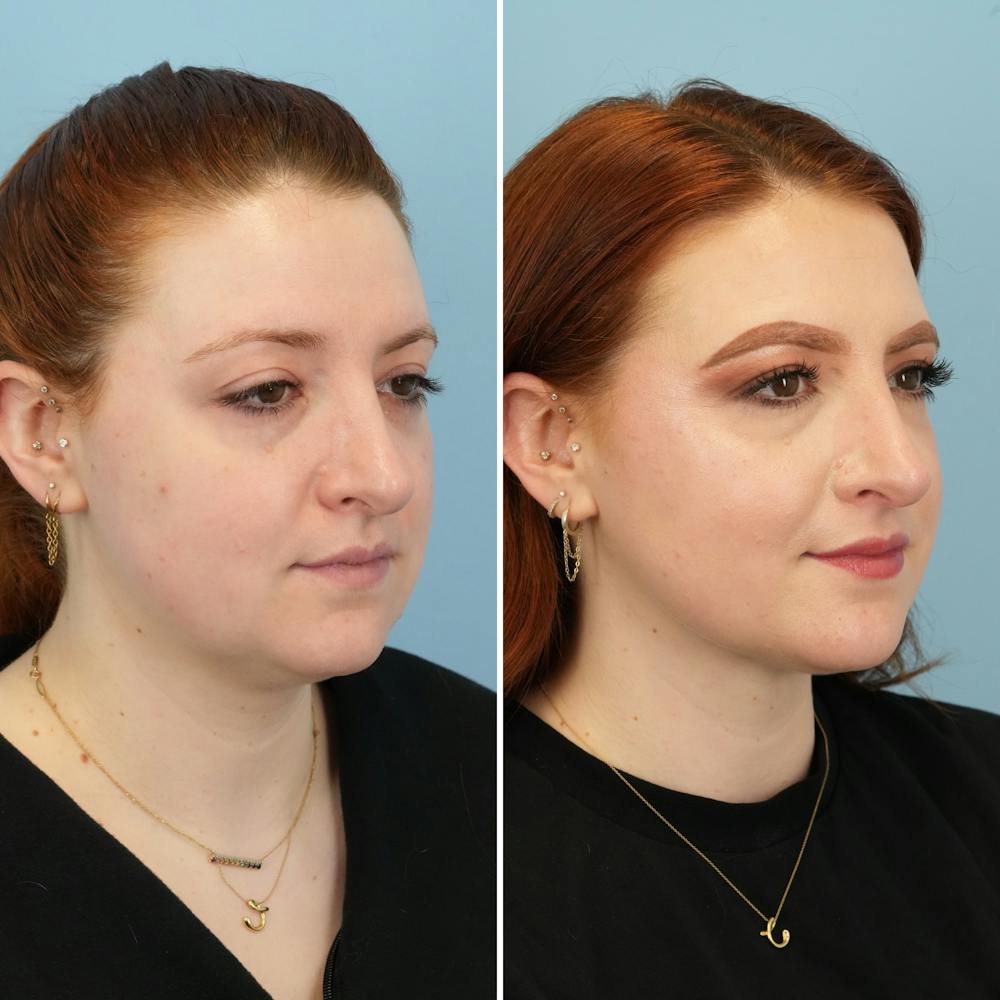 THERMItight Before & After Gallery - Patient 174293 - Image 5