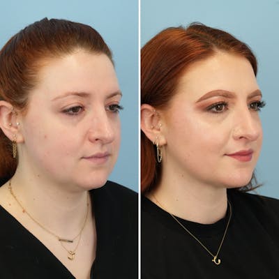 Submental Liposuction Before & After Gallery - Patient 495068 - Image 4