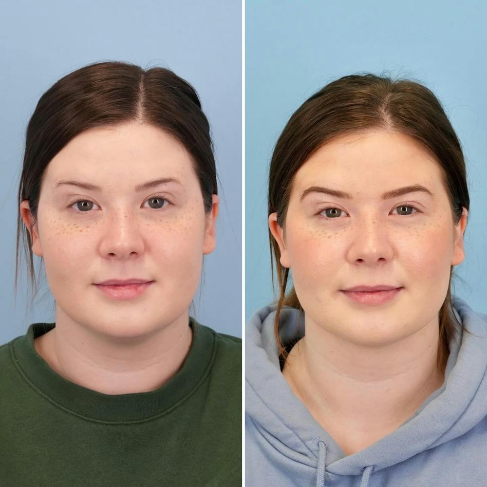 THERMItight Before & After Gallery - Patient 407962 - Image 3