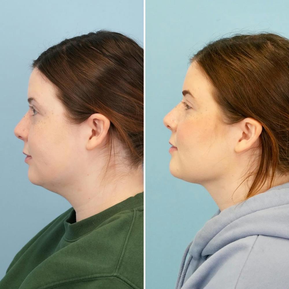 THERMItight Before & After Gallery - Patient 407962 - Image 4