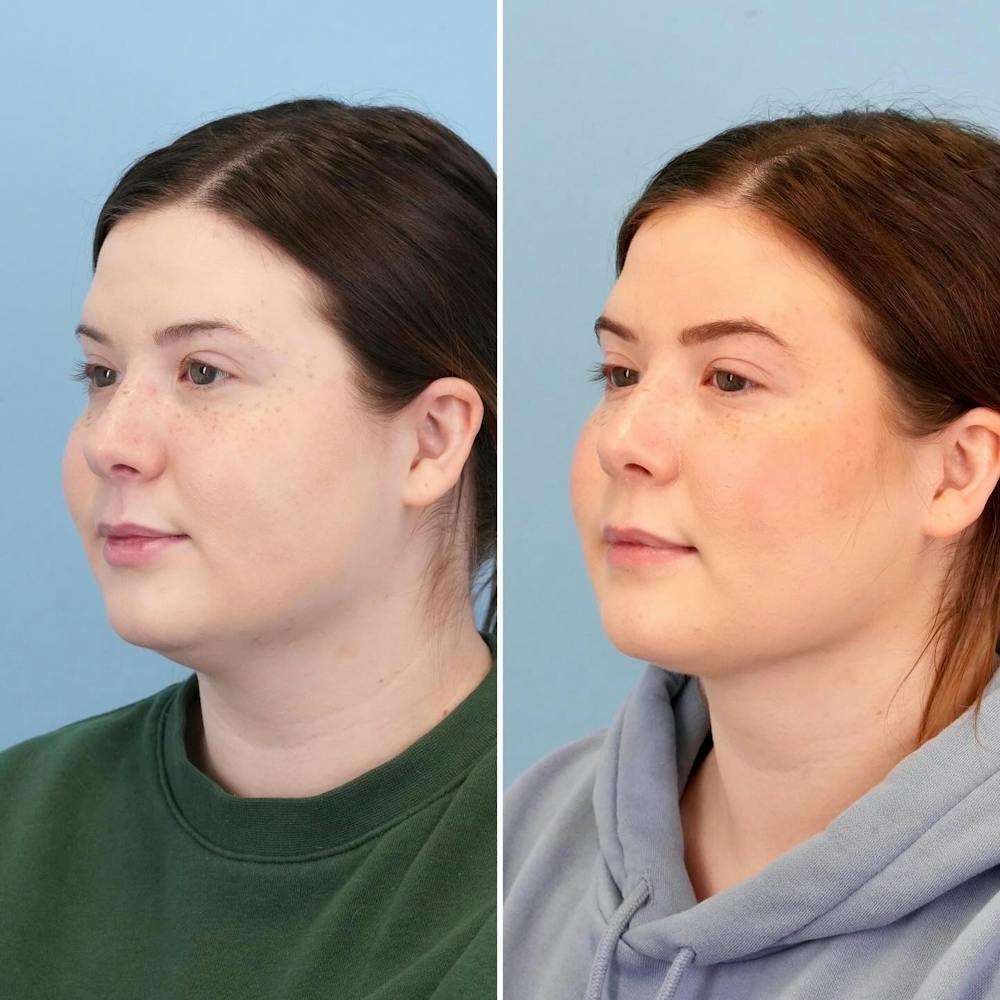 THERMItight Before & After Gallery - Patient 407962 - Image 5