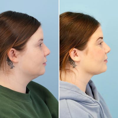 THERMItight Before & After Gallery - Patient 407962 - Image 1