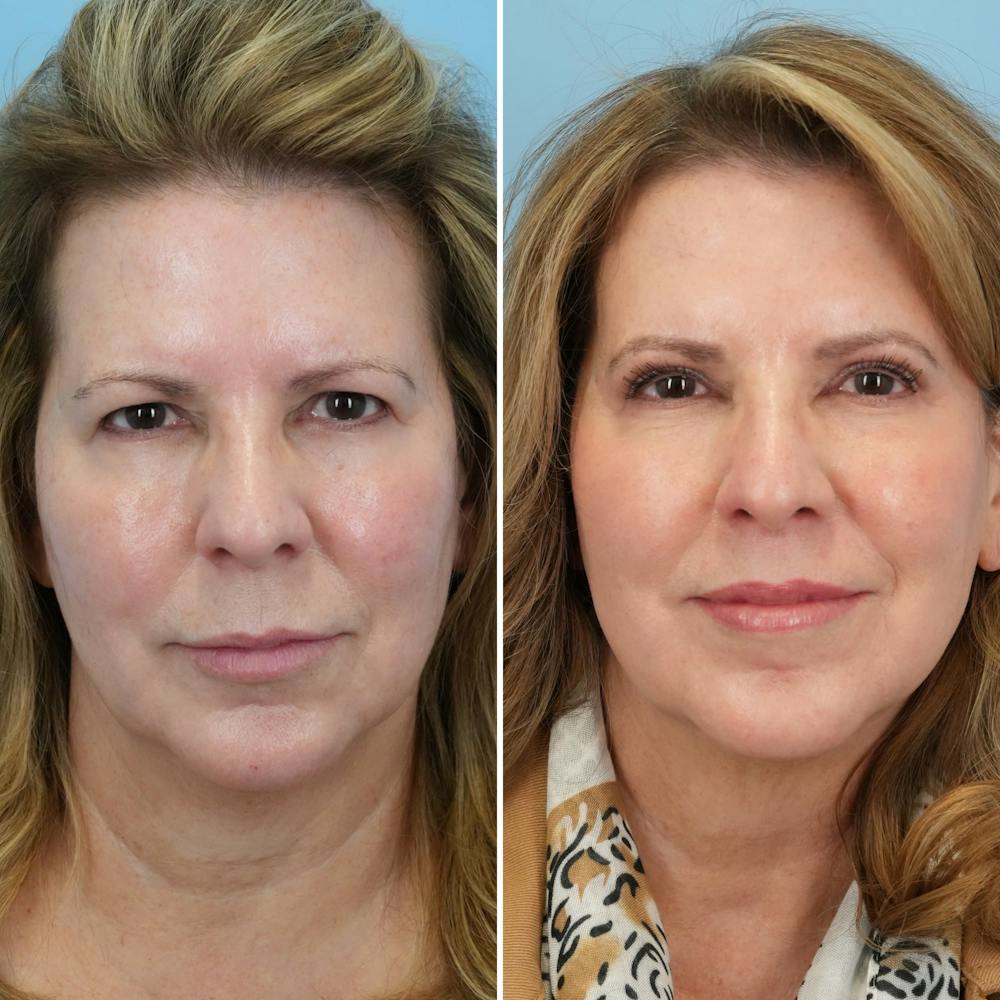Lip Lift Before & After Gallery - Patient 144687157 - Image 1
