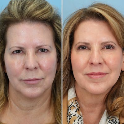 Lip Lift Before & After Gallery - Patient 144687157 - Image 1