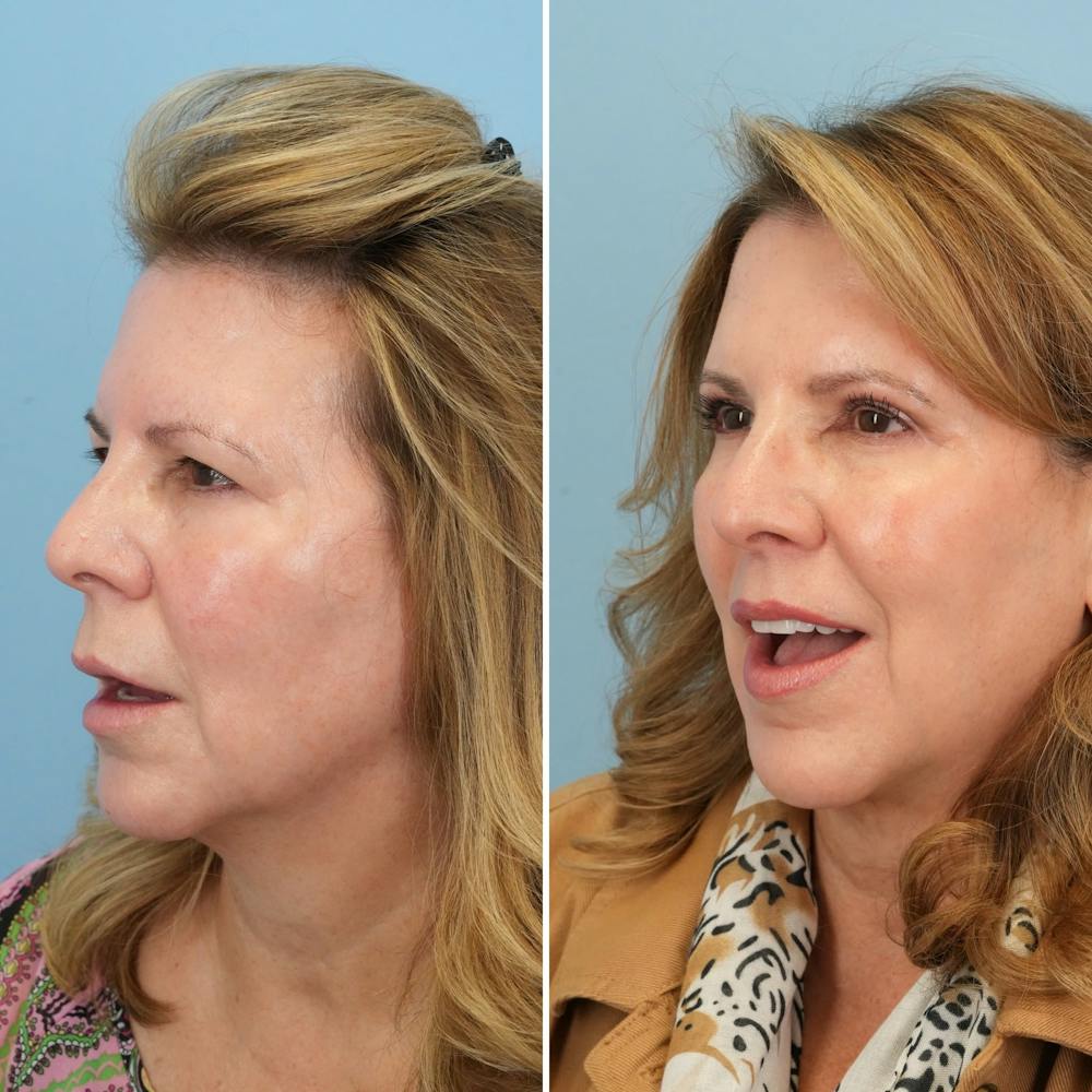 Lip Lift Before & After Gallery - Patient 144687157 - Image 2