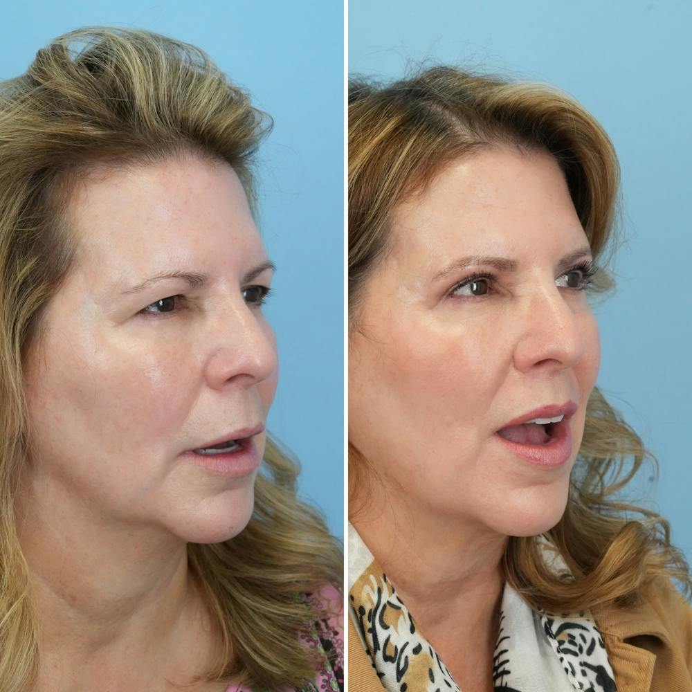 Lip Lift Before & After Gallery - Patient 144687157 - Image 3