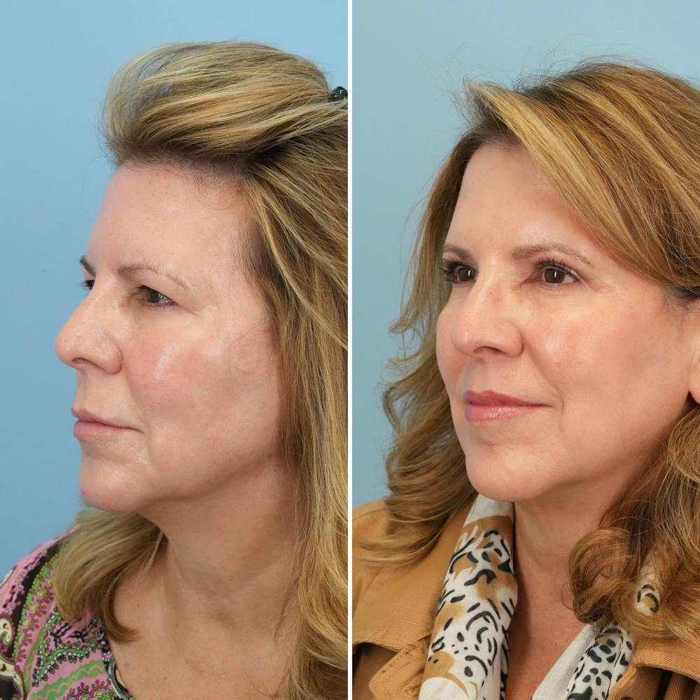 Lip Lift Before & After Gallery - Patient 144687157 - Image 5