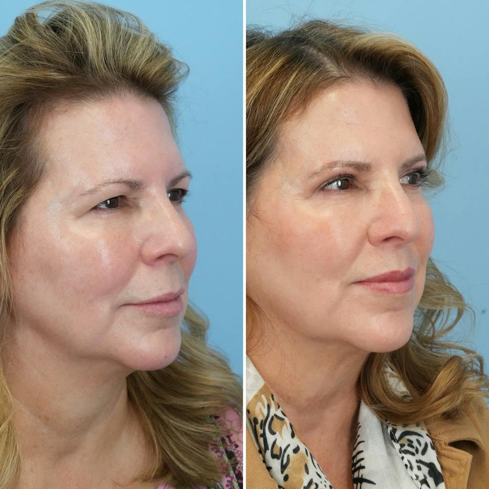 Lip Lift Before & After Gallery - Patient 144687157 - Image 6