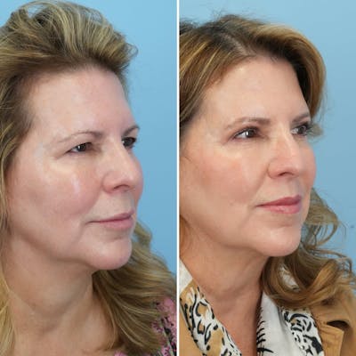 Lip Lift Before & After Gallery - Patient 144687157 - Image 6