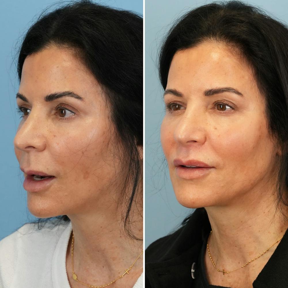Lip Lift Before & After Gallery - Patient 226429 - Image 4