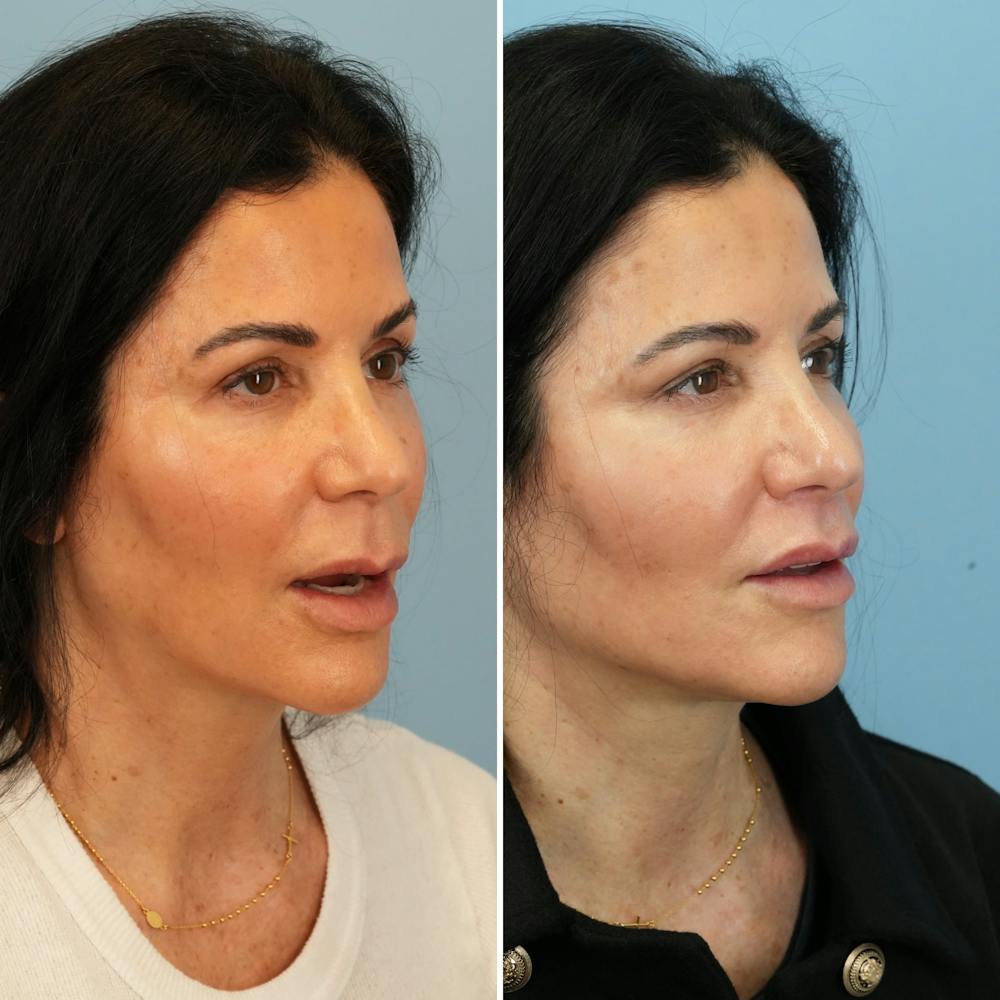 Lip Lift Before & After Gallery - Patient 226429 - Image 5