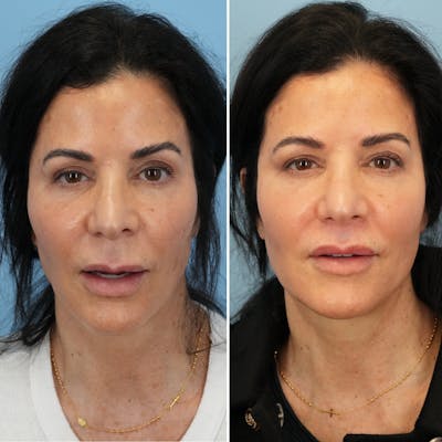 Lip Lift Before & After Gallery - Patient 226429 - Image 2