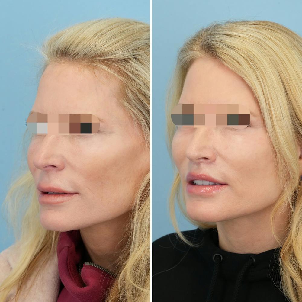 Lip Lift Before & After Gallery - Patient 397401 - Image 3