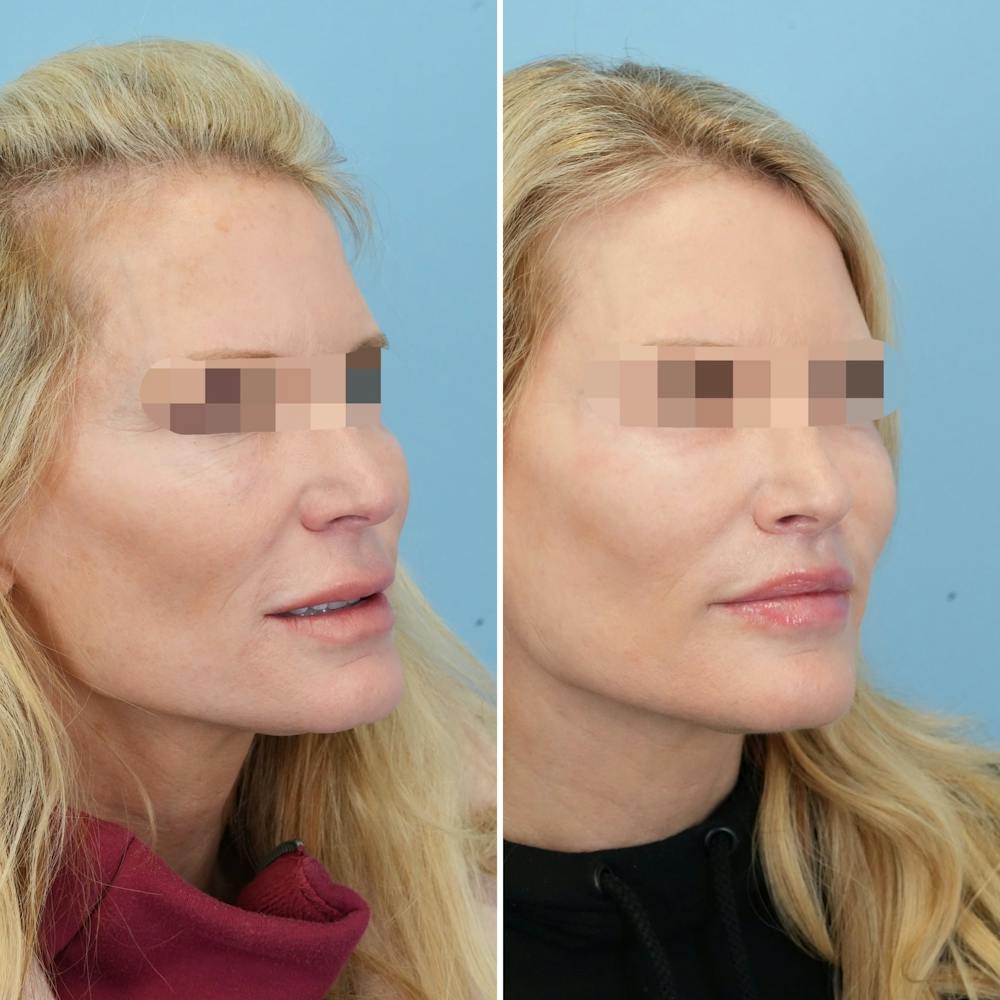 Lip Lift Before & After Gallery - Patient 397401 - Image 4