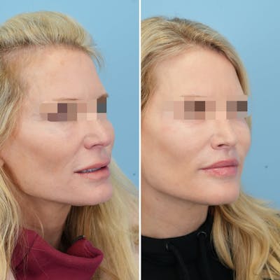 Lip Lift Before & After Gallery - Patient 397401 - Image 4