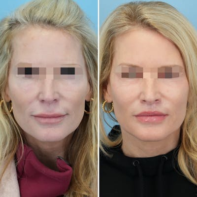 Lip Lift Before & After Gallery - Patient 397401 - Image 1