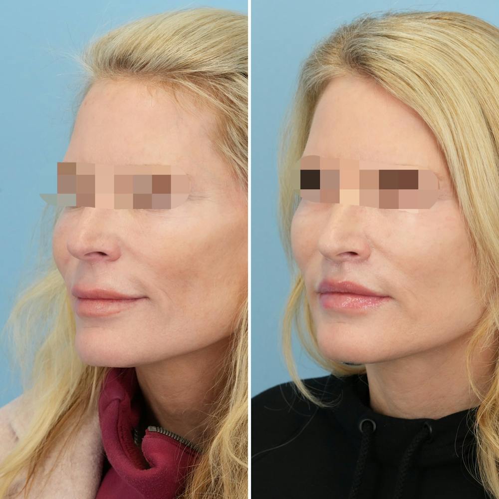 Lip Lift Before & After Gallery - Patient 397401 - Image 6