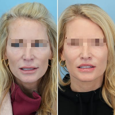 Lip Lift Before & After Gallery - Patient 397401 - Image 2