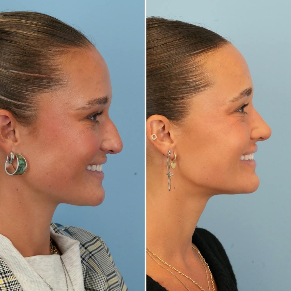 Rhinoplasty Before & After Gallery - Patient 212062 - Image 2