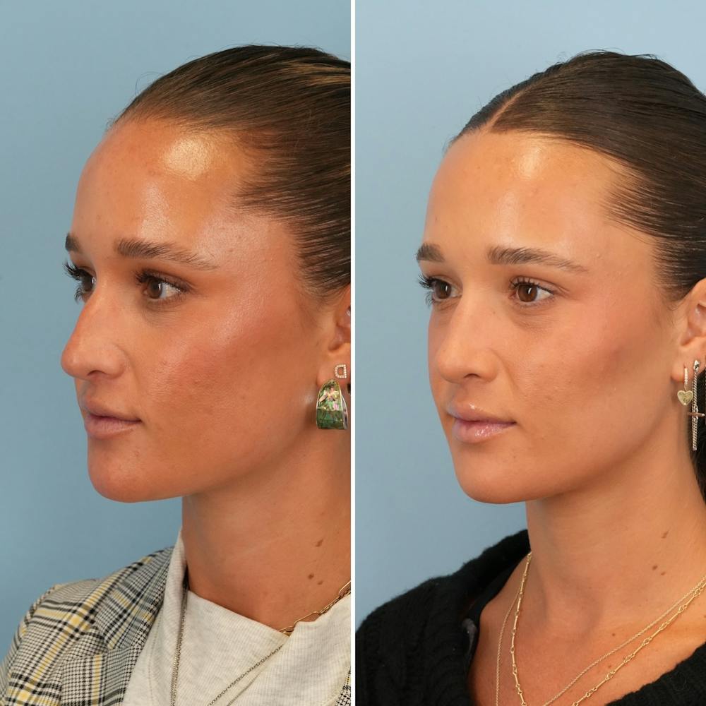 Rhinoplasty Before & After Gallery - Patient 212062 - Image 4