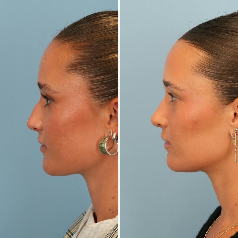 Rhinoplasty Before & After Gallery - Patient 212062 - Image 6