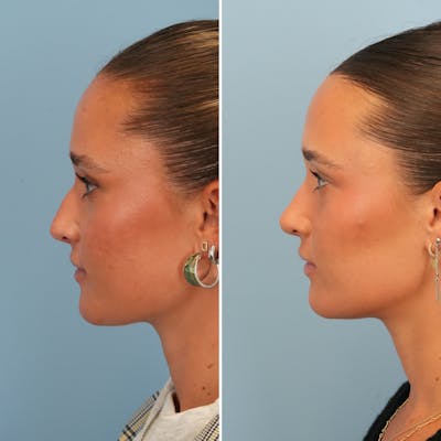 Rhinoplasty Before & After Gallery - Patient 212062 - Image 6
