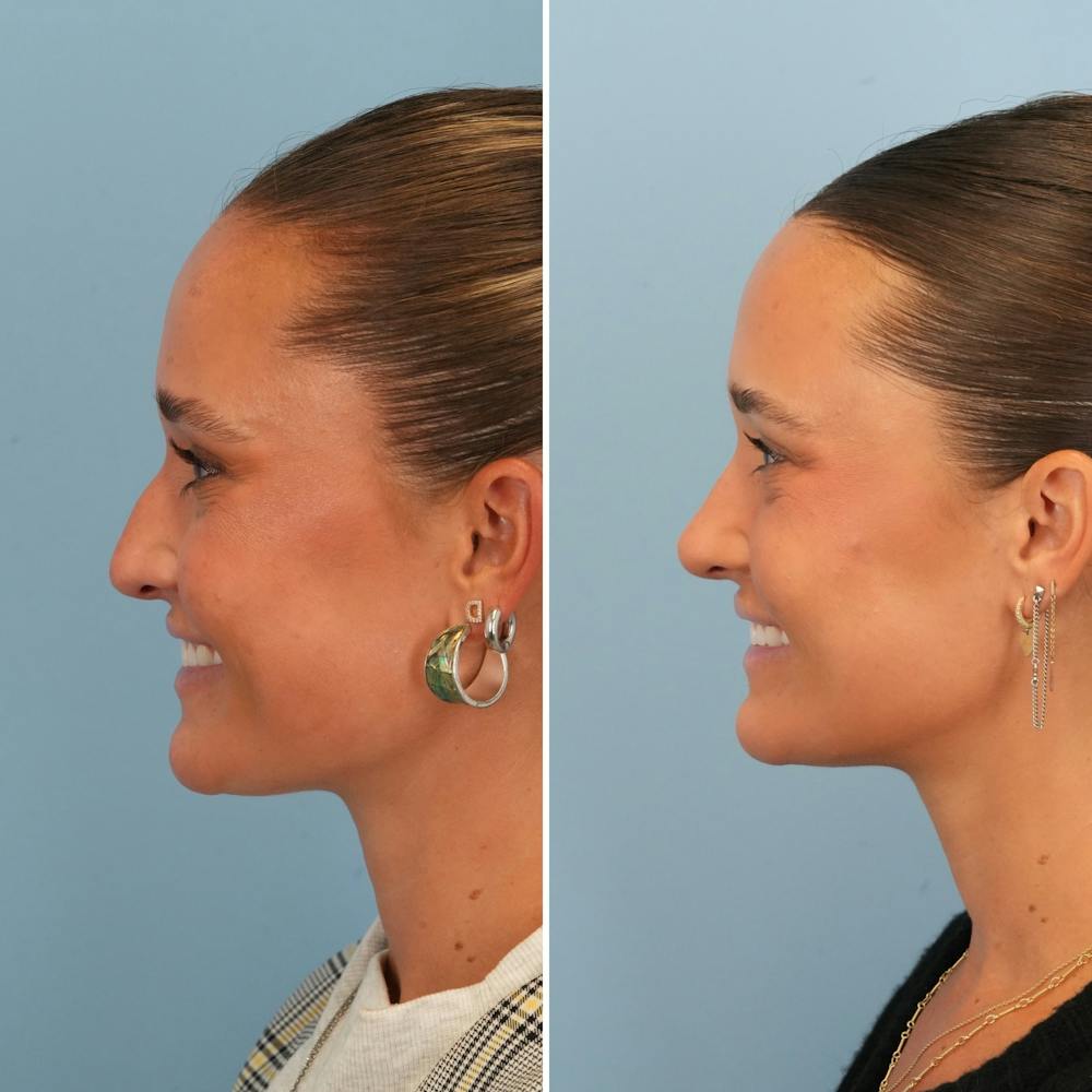 Rhinoplasty Before & After Gallery - Patient 212062 - Image 5