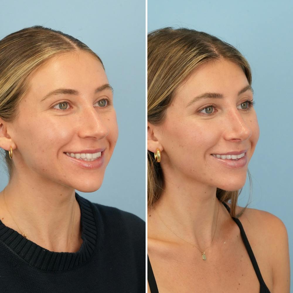 Rhinoplasty Before & After Gallery - Patient 386388 - Image 4