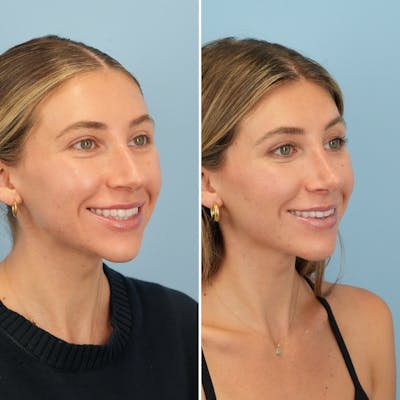 Rhinoplasty Before & After Gallery - Patient 386388 - Image 4