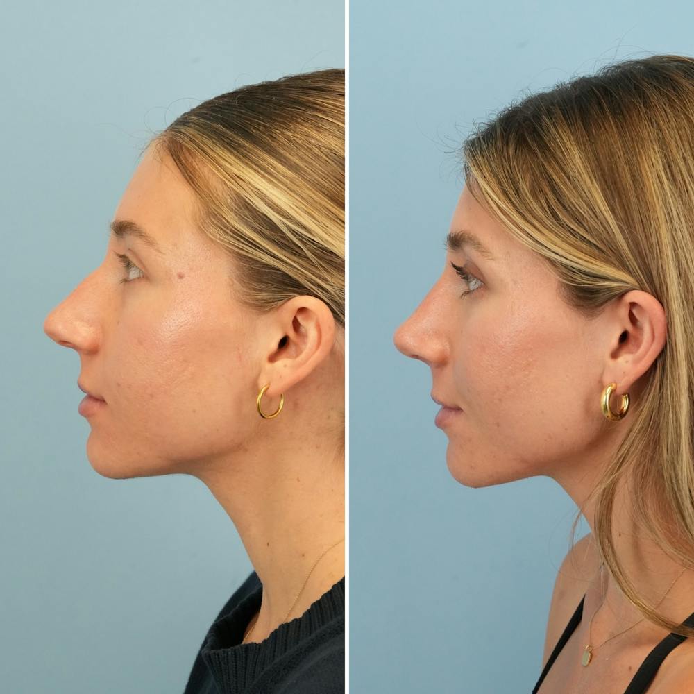Rhinoplasty Before & After Gallery - Patient 386388 - Image 9