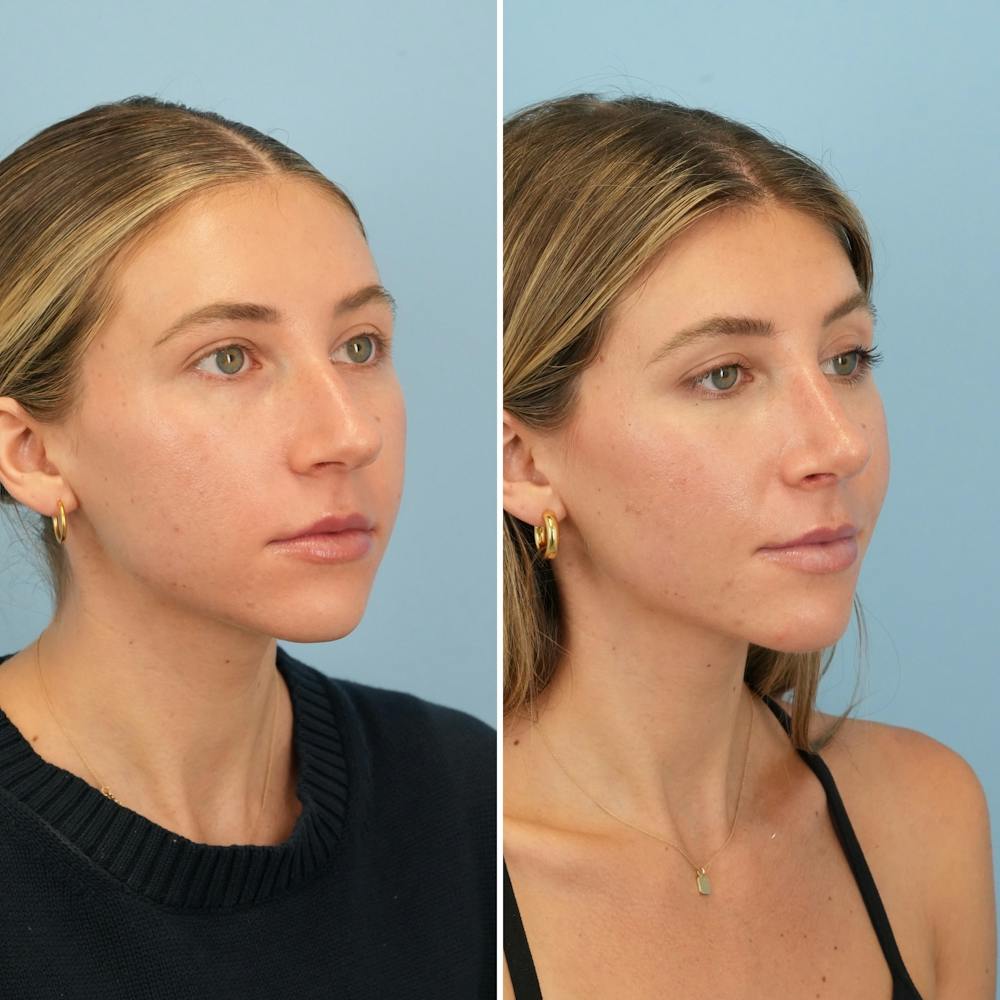 Rhinoplasty Before & After Gallery - Patient 386388 - Image 3