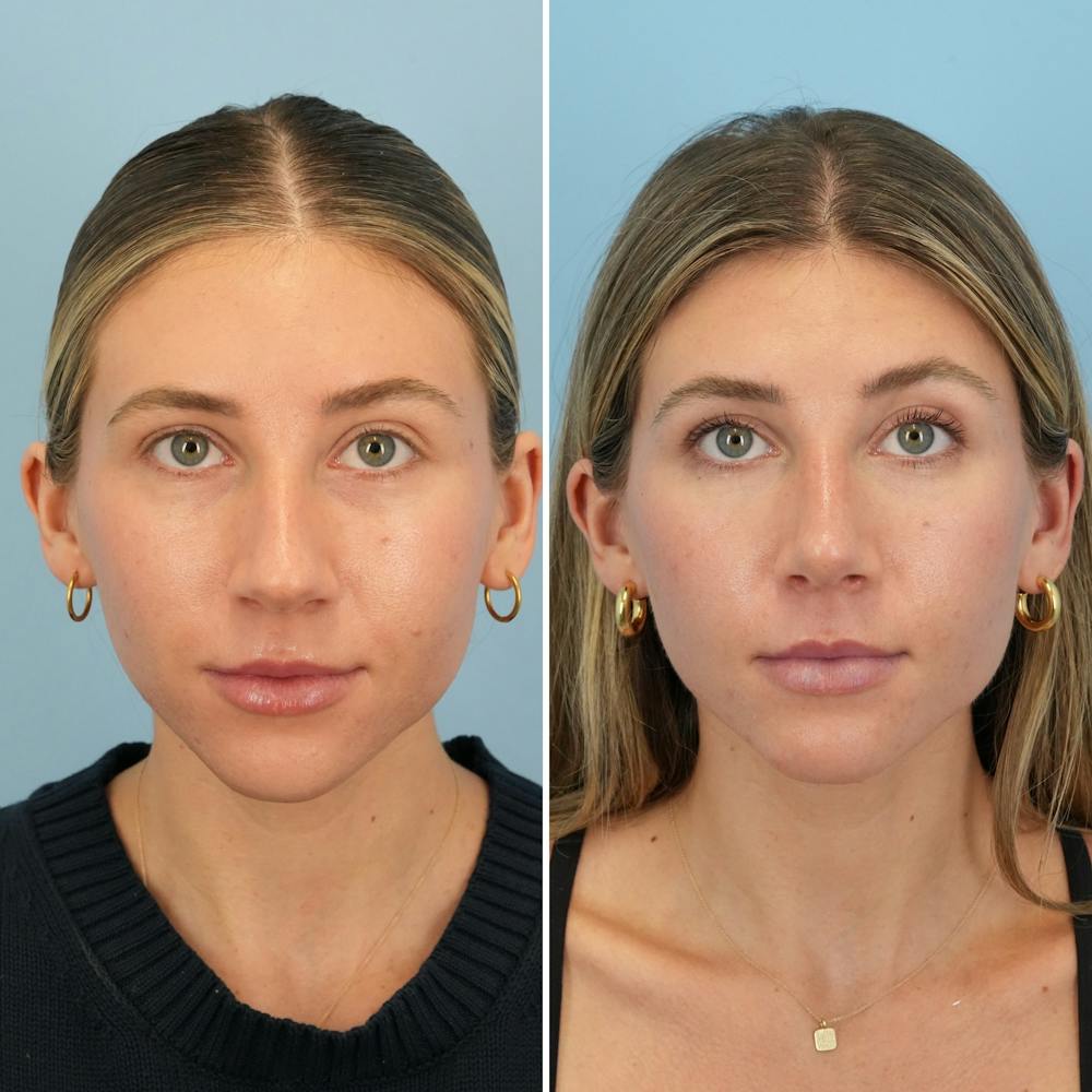 Rhinoplasty Before & After Gallery - Patient 386388 - Image 5