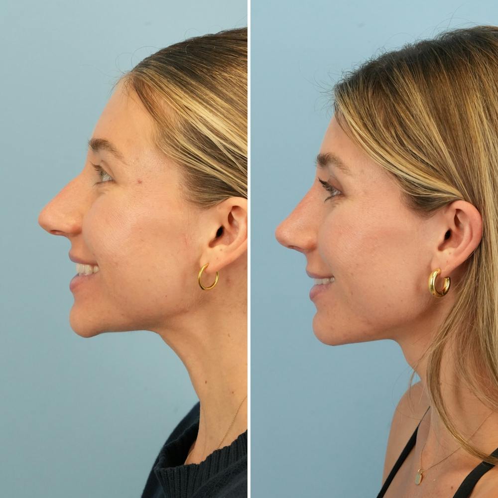 Rhinoplasty Before & After Gallery - Patient 386388 - Image 8