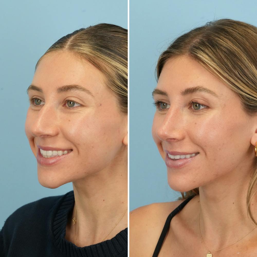 Rhinoplasty Before & After Gallery - Patient 386388 - Image 7