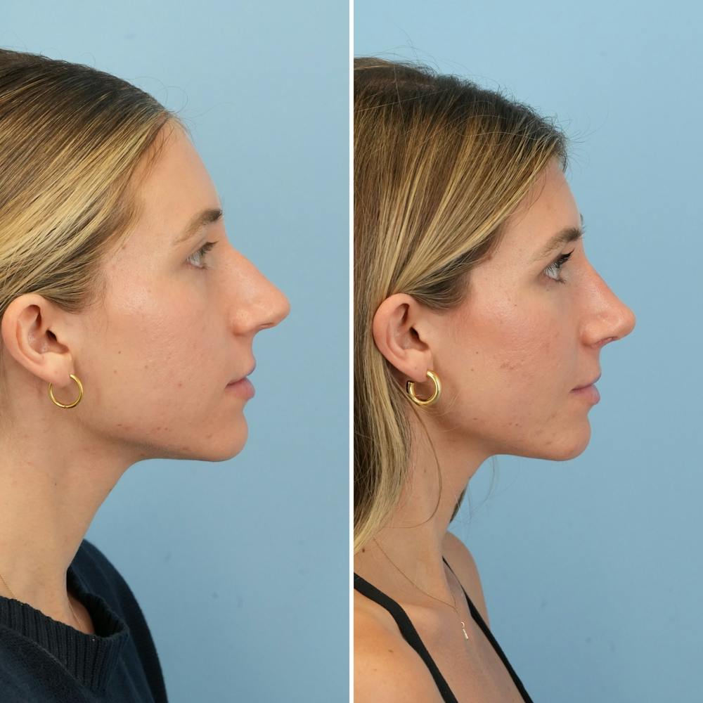 Rhinoplasty Before & After Gallery - Patient 386388 - Image 1