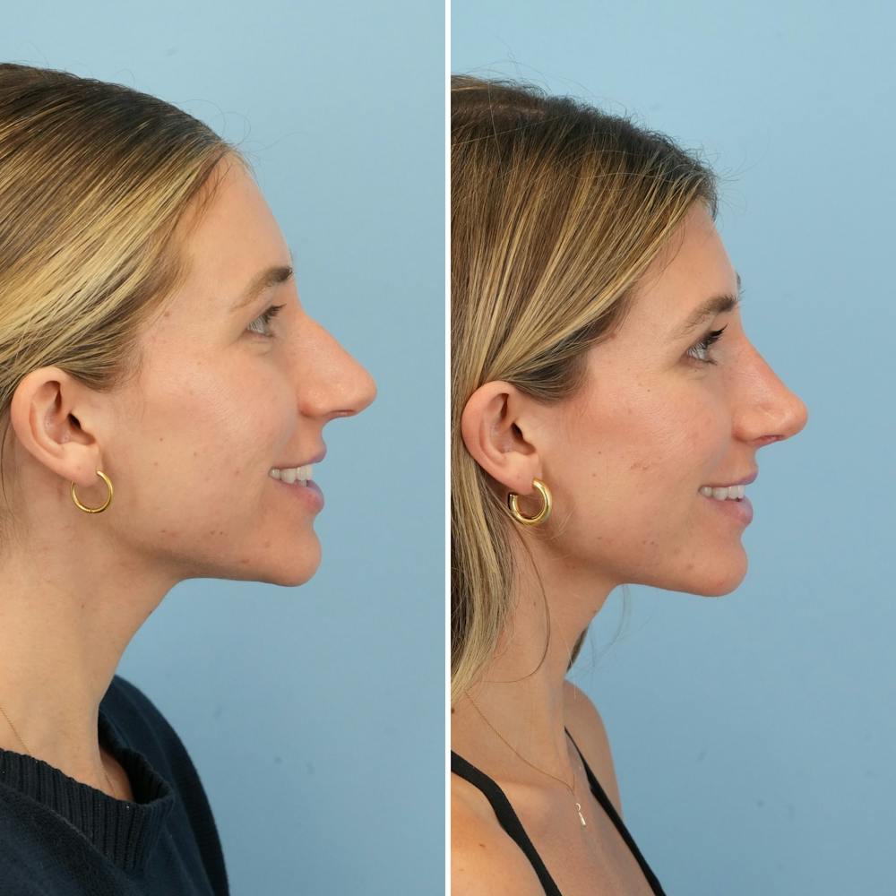 Rhinoplasty Before & After Gallery - Patient 386388 - Image 2