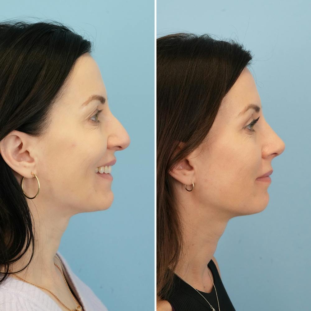 Rhinoplasty Before & After Gallery - Patient 285654 - Image 2