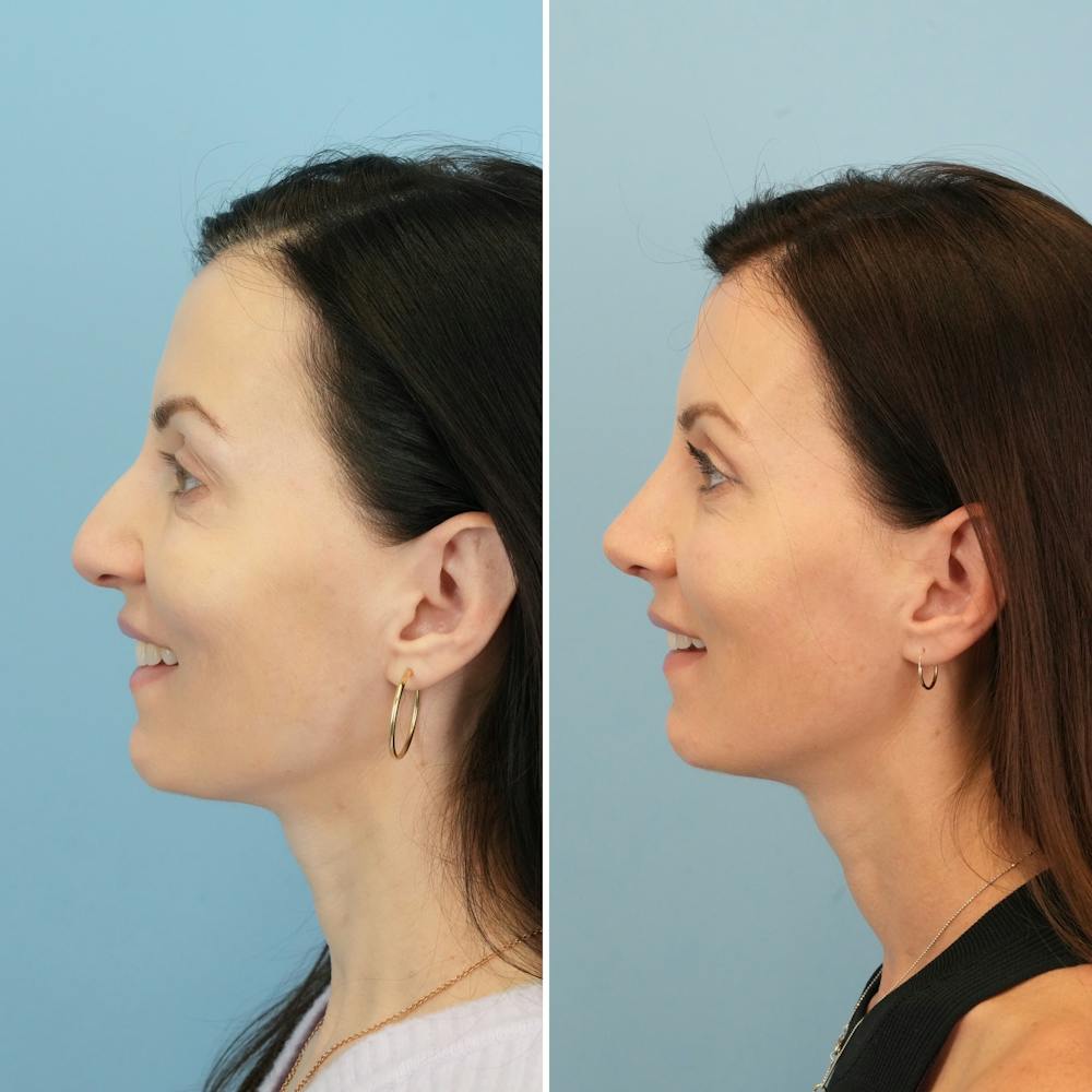 Rhinoplasty Before & After Gallery - Patient 285654 - Image 6
