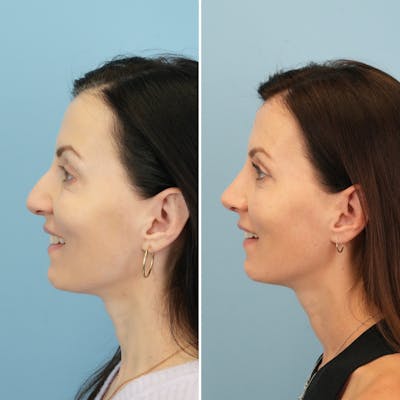 Rhinoplasty Before & After Gallery - Patient 285654 - Image 6